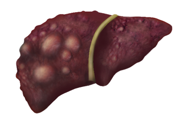 Liver disease